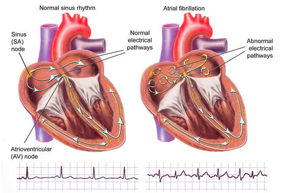 How to live with Atrial Fibrillation? - Cardio Wellness Insights